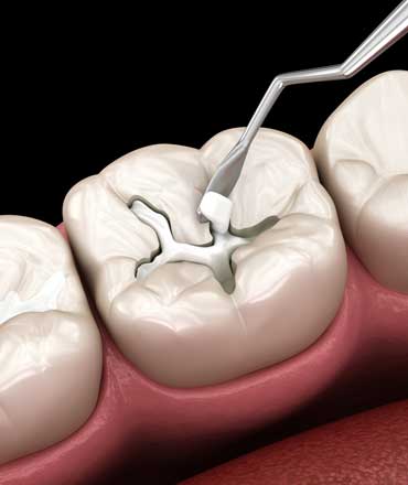 Dental Fillings Brentwood