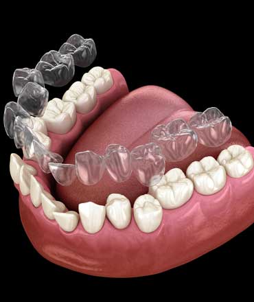 Invisalign Brentwood